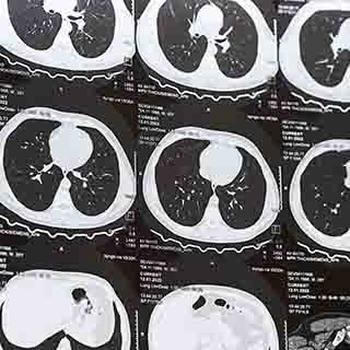 CT Lung Image