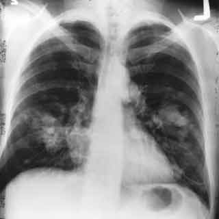 Lung Scan